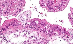 cancer de l'ovaire